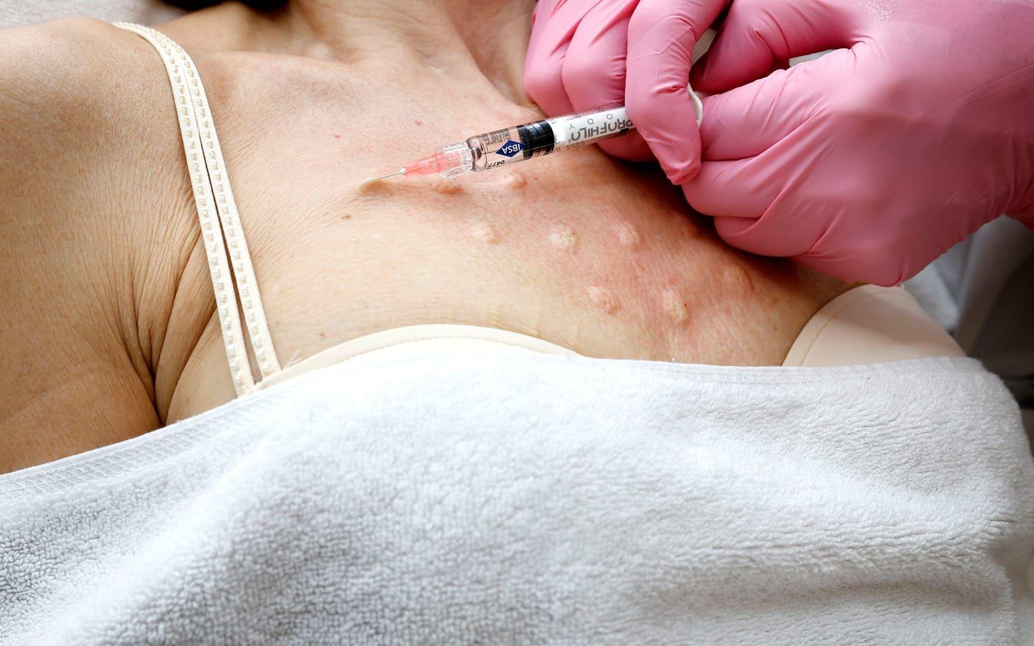 Microneedling